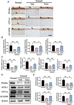 Fenofibrate suppresses corneal neovascularization by regulating lipid metabolism through PPARα signaling pathway